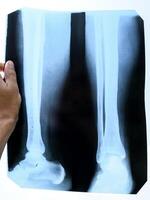 verschmolzen Knochen von das niedriger Bein nach entfernen das Stahl Verbindung Teller foto