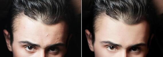 Vor und nach kosmetisch Betrieb. jung Mann Porträt foto