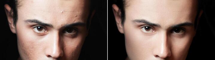 Vor und nach kosmetisch Betrieb. jung Mann Porträt foto