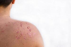 Occipital Akne im ein Teenager Junge geheilt, Narben von Teenager Akne auf das Schultern, Haut Infektionen und Allergien zu das Körper von ein Mann, Gesundheitswesen und medizinisch Konzept foto