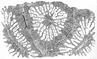 Leber, Amyloid Infiltration, Jahrgang Gravur. foto