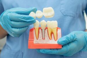 Dental implantieren, künstlich Zahn Wurzeln in Kiefer, Wurzel Kanal von Dental Behandlung, Gummi Krankheit, Zähne Modell- zum Zahnarzt studieren Über Zahnheilkunde. foto