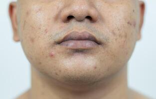 Haut Probleme. Problem von entzündet Akne auf das Gesicht. entzündet Akne besteht von Schwellung, Rötung, und Poren Das sind stark verstopft mit Bakterien, Öl, und tot Haut Zellen. foto