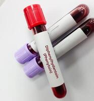 Blut Stichprobe zum Phenytoin prüfen, therapeutisch Arzneimittel, zu pflegen ein therapeutisch Niveau und diagnostizieren Potenzial zum Toxizität foto