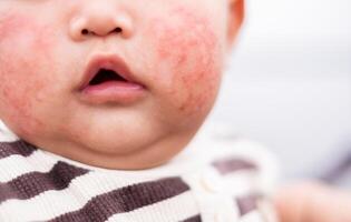 rot Ausschlag mit Juckreiz fällig Staub oder Allergie auf Baby Gesicht, Pilz, Allergie, dermatologisch Krankheit, trocken Haut. Gesundheitswesen und medizinisch Konzept. foto