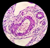 Histologie, peritoneal Aufnahme Zyste. Paraovariell Zysten, Hydrosalpinx und minderwertig zystisch Mesotheliom sind in der Regel berücksichtigt im das Differential Diagnose von Bilder. foto