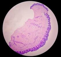 histologisch Mikrofotografie. Juckreiz nodularis oder pn ist ein chronisch Störung von das Haut. foto