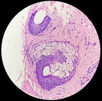 histologisch Mikrofotografie. Juckreiz nodularis oder pn ist ein chronisch Störung von das Haut. foto