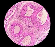 Histologie, peritoneal Aufnahme Zyste. Paraovariell Zysten, Hydrosalpinx und minderwertig zystisch Mesotheliom sind in der Regel berücksichtigt im das Differential Diagnose von Bilder. foto