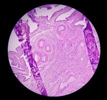 Histologie, peritoneal Aufnahme Zyste. Paraovariell Zysten, Hydrosalpinx und minderwertig zystisch Mesotheliom sind in der Regel berücksichtigt im das Differential Diagnose von Bilder. foto