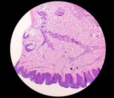 histologisch Mikrofotografie. Juckreiz nodularis oder pn ist ein chronisch Störung von das Haut. foto