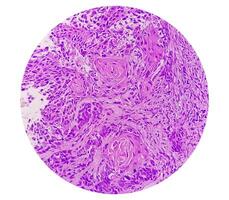 Histologie, peritoneal Aufnahme Zyste. Paraovariell Zysten, Hydrosalpinx und minderwertig zystisch Mesotheliom sind in der Regel berücksichtigt im das Differential Diagnose von Bilder. foto