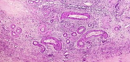 Histologie, peritoneal Aufnahme Zyste. Paraovariell Zysten, Hydrosalpinx und minderwertig zystisch Mesotheliom sind in der Regel berücksichtigt im das Differential Diagnose von Bilder. foto