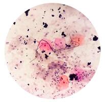 Mikrophotographie von Paps Abstrich. entzündlich Abstrich mit vaginal Candidiasis . medizinisch Konzept. foto