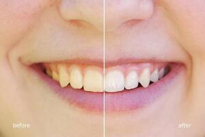 Zähne Bleaching Vor und nach foto