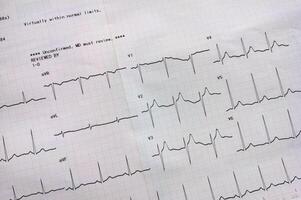 Graph zeigen das Ergebnisse von das Elektrokardiogramm Prüfung auf Aufzeichnung Papier. foto