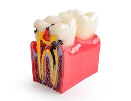 Zahn Verfall, Dental implantieren, künstlich Zahn Wurzeln in Kiefer, Wurzel Kanal, Gummi Krankheit, Zähne Modell- isoliert auf Weiß Hintergrund mit Ausschnitt Weg. foto