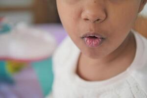 schließen oben von trocken Lippe von ein Kind foto