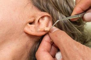 Frau, bei der eine Ohrakupunkturbehandlung durchgeführt wurde, bei der die Ohrstecker entfernt wurden foto