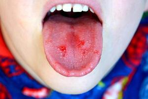 Nahansicht von Lippen, Zunge, Vorsprung von Blut. Kinder gebissen Zunge. foto