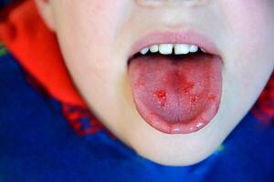 Nahansicht von Lippen, Zunge, Vorsprung von Blut. Kinder gebissen Zunge. foto