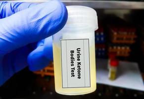 Medizintechniker halten Behälter mit Urinprobe für Urinketonkörpertest foto