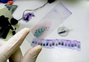 Arzt hält Buntglas-Objektträger mit Blutausstrich mit violettem Leishman-Giemsa-Fleck in der Hämatologie-Abteilung. foto