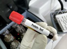 Blutprobe für Proteintest. Wissenschaftler hält Blutröhrchen für Labortests. Leberfunktionstest. Gesamtprotein foto