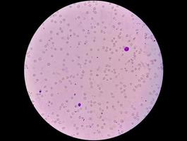 Mikrophotographie einer leuko-erythroblastischen Anämie. 40x foto