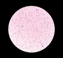 Mikrophotographie einer leuko-erythroblastischen Anämie. foto