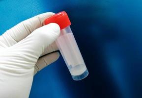 Sperma in einem Topf zur Analyse an der Hand des Arztes. menschliche Fruchtbarkeitsdiagnose Spermien zählen mikroskopisch mit blauem Hintergrund. Samenanalyse