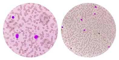 Blutbild der akuten myeloischen Leukämie-aml. mit dem Mikroskop analysieren foto