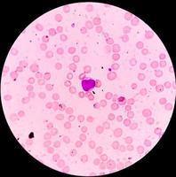 Mikroskopische Ansicht von akuter myeloischer Leukämie, myeloblastischer Leukämie, einem Krebs der weißen Blutkörperchen foto