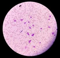 mikroskopische Ansicht von akuter myeloischer Leukämie, myeloblastischer Leukämie, einem Krebs der weißen Blutkörperchen. 10x foto