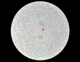 Mikrophotographische Ansicht eines abnormalen hämatologischen Objektträgers. 10x foto