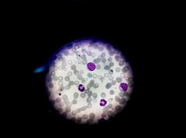 Mikroskopische Ansicht des gefärbten Objektträgers der Hämatologie im Labor. Nahansicht. Gesamtblutbild. foto