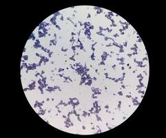 Mikroskopische Ansicht der Kälteagglutinin-Krankheit. autoimmunhämolytische Anämie. cad foto