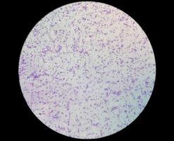Wichtiger Thrombozytose-Blutausstrich, der ein abnormal hohes Volumen an Blutplättchen und weißen Blutkörperchen zeigt, Analyse mit dem Mikroskop. essentielle Thrombozythämie oder Thrombozytopenie. Mikroskopische Ansicht des Objektträgers. foto