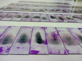 Buntglas-Objektträger von peripherem Blutausstrich mit violetter Leishman-Giemsa-Färbung werden in der hämatologischen Abteilung isoliert, die für die mikroskopische Untersuchung bereit ist foto
