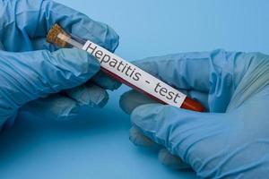 Hepatitis-Test, Blut im Reagenzglas. foto