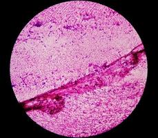 Mikrophotographie eines metastasierten Adenokarzinoms der Lunge foto