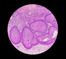 Mikrophotographie eines sinonasalen invertierten Papilloms, eines gutartigen Tumors, der in der Nasenhöhle oder den Nasennebenhöhlen auftreten kann, 40x foto