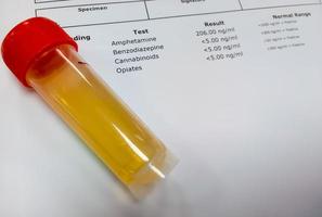 Urinprobe für Drogentest. Drogentest ist eine technische Analyse von Proben, um illegalen Drogenmissbrauch wie Benzodiazepine, Cannabis, Amphetamine, Opiate festzustellen. foto