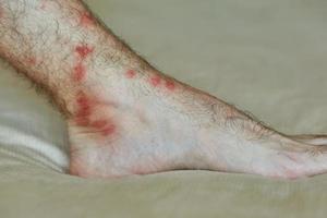 männlicher Fuß mit vielen roten Flecken und Narben von Insektenstichen. foto