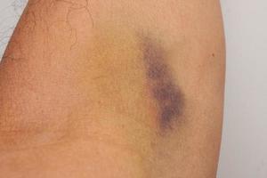 Mann mit einem großen blauen Fleck am Arm von einem iv oder intravenösen Tropf foto