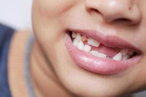 Teenager-Kind mit einem ausgefallenen Zahn Teenager-Kind mit einem ausgefallenen Zahn foto
