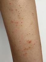 Junge hat chronischen Hautausschlag. Grasallergische Hautkrankheit. atopische Dermatitis. Altersfleckenhaut foto