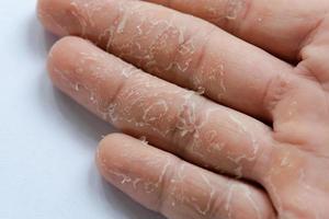 Abschälen der Haut an Hand und Fingern. Abschuppung foto