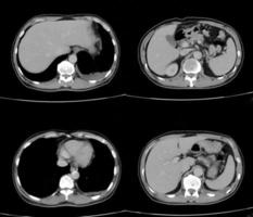 Transversalansicht oder axialer einfacher CT-Thorax zeigen infitrative Masse und Knötchen am Oberlappen. foto