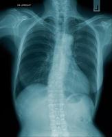 Brust-Röntgenbild in blauem Hintergrund, Lungeninfektion mit Sekret foto